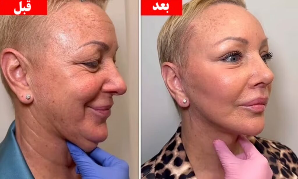 این زن ۶۰ ساله پس از عمل زیبایی ۳۰ سال جوان تر شد و همه را شگفت‌زده کرد + ویدیو