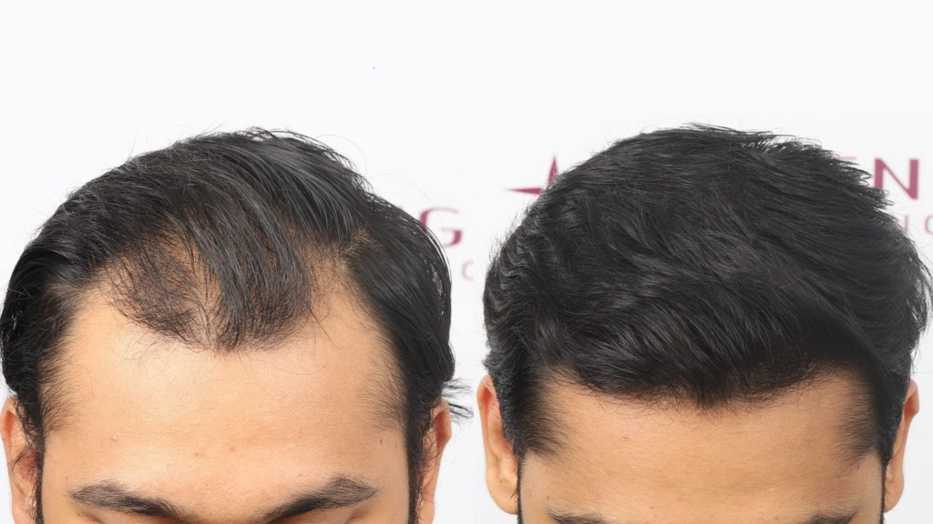 کاشت مو به روش میکروگرافت چیست و هزینه اش چقدر است؟