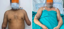 پیوند دست یک زن به مرد نقاشی که هر دو دست خود را در سانحه قطار از دست داد