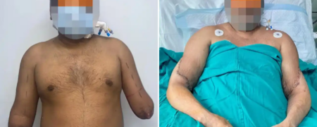 پیوند دست یک زن به مرد نقاشی که هر دو دست خود را در سانحه قطار از دست داد