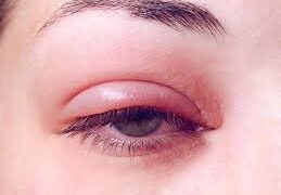 گل مژه + عوامل آن + انواع و درمان