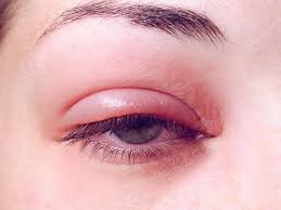 گل مژه + عوامل آن + انواع و درمان