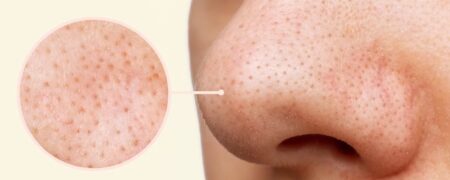 بهترین و بدترین روش‌ها برای از بین بردن جوش‌های سرسیاه