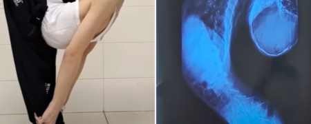 نزدیک شدن «پسر تا شده» به ایستادن پس از جراحی صاف کردن ستون فقراتش + ویدیو