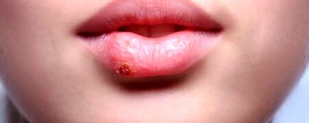 چرا تبخال می زنیم و چطور باید از شر آن خلاص شویم؟